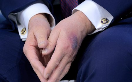 White House explains bruise on Trump's hand