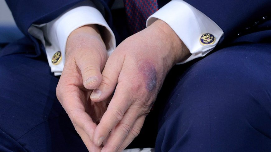 White House explains bruise on Trump's hand