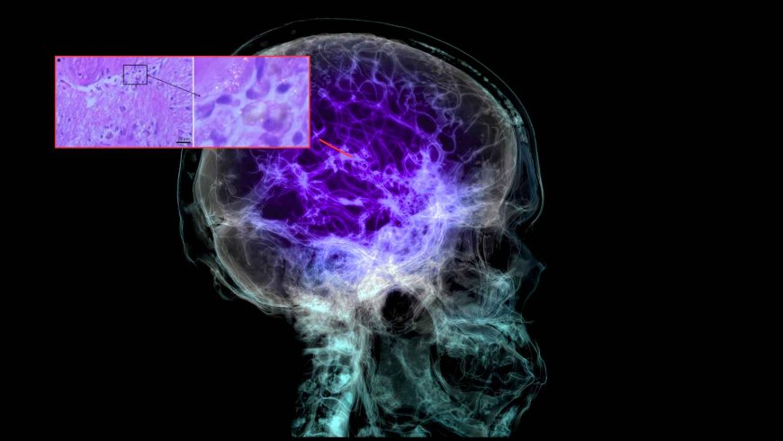 Your brain may be accumulating microplastics, and the big question is no longer whether they are there, but what they might be doing