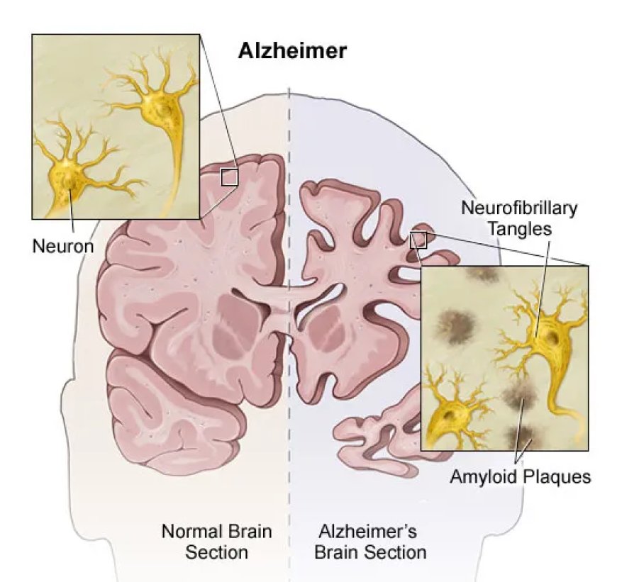 Dementia & Alzheimer’s Disease Cure Protocol