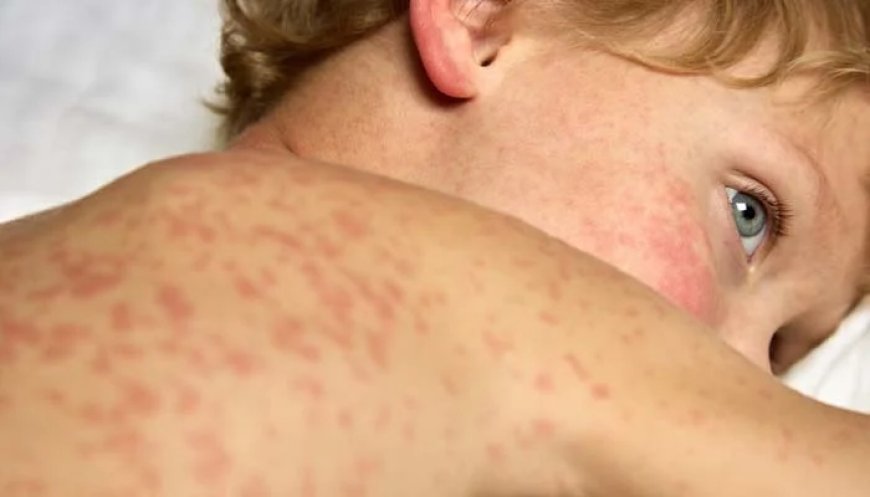 BREAKING STUDY: MMR and MMRV vaccines linked to 2,657% more U.S. deaths than measles infection since 1995