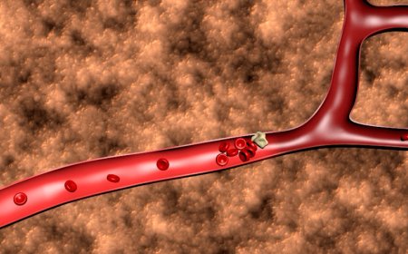 Wichita experts on how you can avoid deadly blood clots