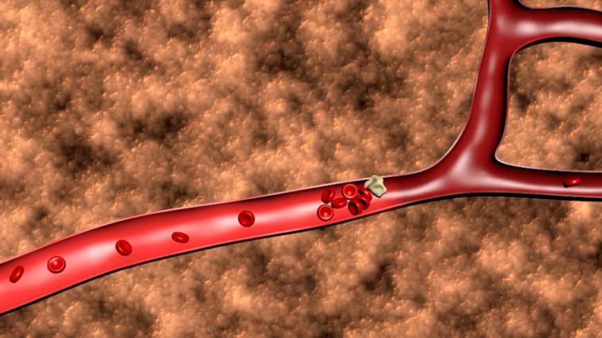 Wichita experts on how you can avoid deadly blood clots