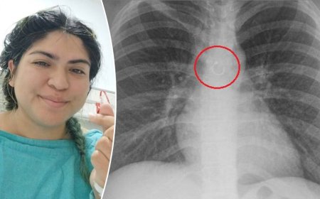 Woman discovers missing nose ring traveled to her lungs, causing month-long cough