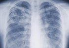 Are you underestimating mold-related illness? What U.S. study says