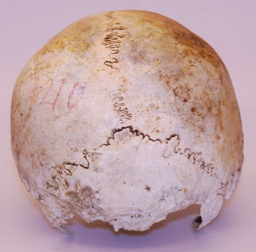 Skull found in 1975 belongs to Uxbridge, Ont. WWI veteran: police