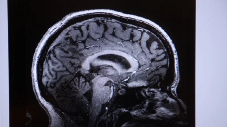 Study: Being Overweight Associated with Reduced Brain Mass