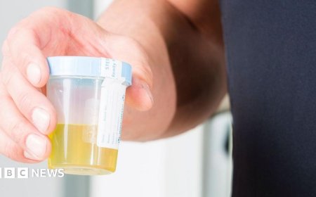 Urine test can spot more than nine in 10 bladder cancers
