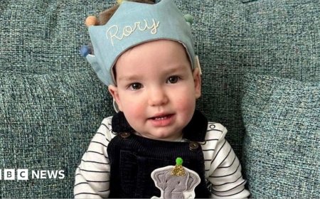 World-first surgery for baby's rare skull condition