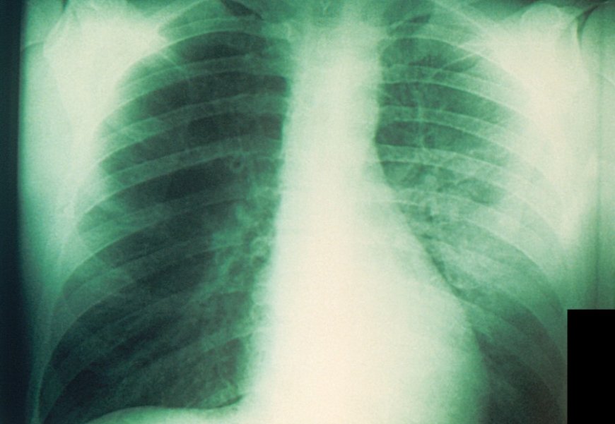 Pneumonic plague: What is it and how dangerous can it be?